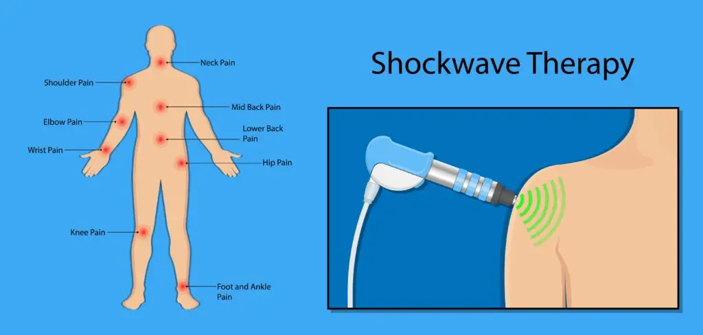 diagram of shockwave therapy treatment areas